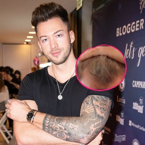 Bachelorette-Boy Keno Rüst lässt sich Haare transplantieren