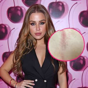 Wegen Ledergurt-Top: Kim Gloss hat fiesen Hautausschlag