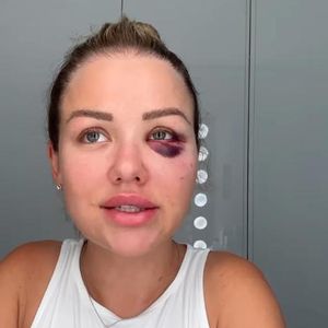 Kim Gloss fiel eine zehn Kilo schwere Hantel aufs Gesicht!