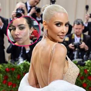 Schuppenflechte ruinierte fast Kim Kardashians Gala-Auftritt