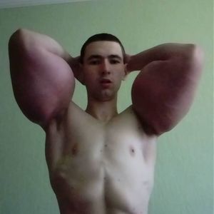 "Dummheit": TikTok-Popeye könnte wegen Bizeps-Filler sterben