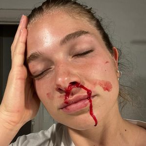 Voller Blut: Moderatorin Lola Weippert schockt Fans mit Foto