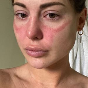 Mehr gesundheitliche Probleme: Louise Thompson hat Ausschlag