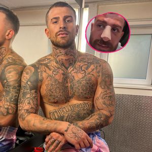 Not-OP bei Gigi: Nase war schon vor Fame Fighting kaputt