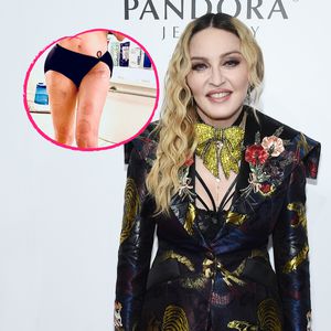 Madonna zeigt ihre Hüftnarbe und zahlreiche Schröpfmale