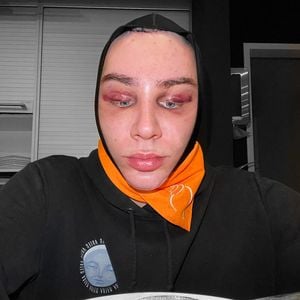Erste Bilder nach OP: So sah Marvyn Macnificent erst aus!