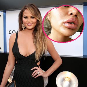Chrissy Teigen mit XL-Lippen: War sie etwa beim Beauty-Doc?