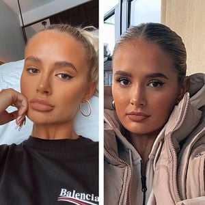 Lipfiller sind raus! Molly-Mae Hague zeigt natürliche Lippen