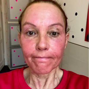 Knallrotes Gesicht: Natascha Ochsenknecht hatte Creme-Panne