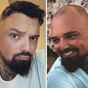 Nach sieben Jahren Glatze: Nik Schröder hat endlich Haare!