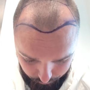 Hier unterzieht sich Nik Schröder einer Haartransplantation!