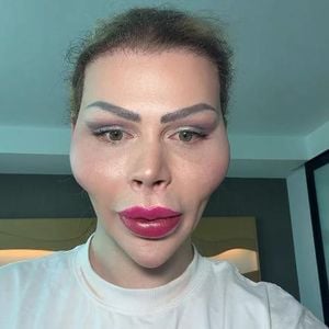 So viel Geld kostete Dschungelbegleitung-Patricks Gesicht