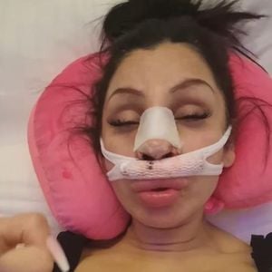 "Todesschmerzen": Pinar Sevim zeigt Gesicht nach Beauty-OP