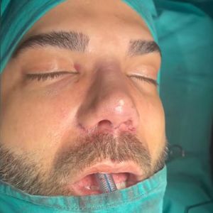 Vor der OP: Rafi Rachek fand seine alte Nase extrem hässlich