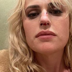 Autsch! Rebel Wilson zeigt blutende Nase nach Stunt-Unfall