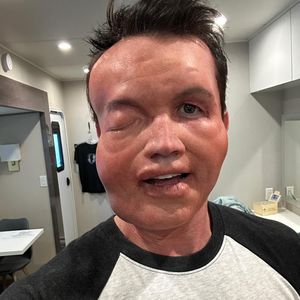 Nussallergie? Rob McElhenney zeigt stark verbeultes Gesicht