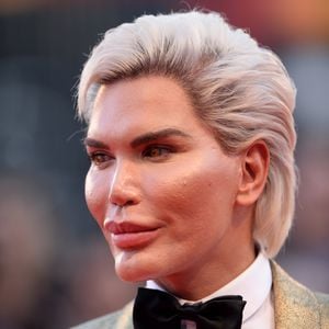 20.000€-Haartransplantation: Real-Life-Ken bald 'ne Barbie?