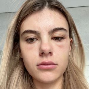 Romina Palm leidet nach Beauty-Eingriff unter Schwellungen