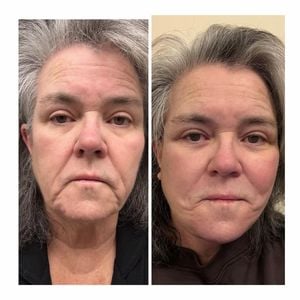 Geheimes Facelift: Rosie O'Donnell zeigt Vorher-Nachher-Foto