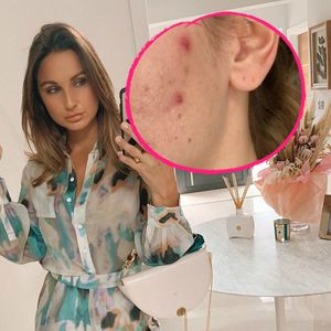 Sam Faiers wollte sich wegen schlimmer Akne wegsperren