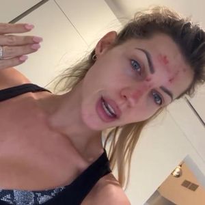 Schrammen: Sarah Harrison erklärt Grund für blutiges Gesicht