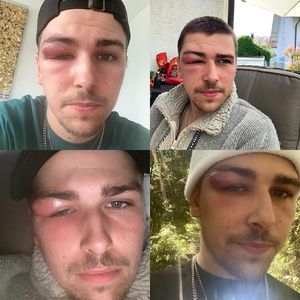 Zyste am Auge: Ex-BTN-Star Matze Höhn nicht wiederzuerkennen