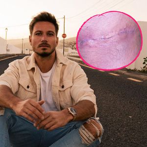 Nach Unfall mit Flex: Sebastian Pannek zeigt seine OP-Narbe