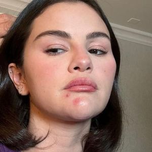 Ungeschminkt: Selena Gomez steht zu ihrer unreinen Haut