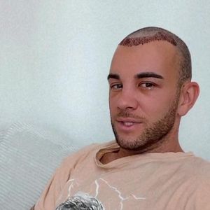 Haartransplantation: Serkan Yavuz' Gesicht ist geschwollen