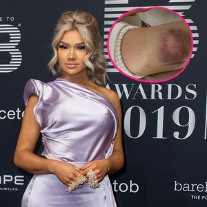Nach Sturz von Treppe: Shirin David zeigt ihr kaputtes Knie