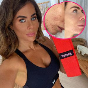 "Hart für mich": Fitness-Mom Sophie Guidolin zeigt ihre Akne