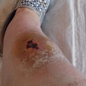 Schwiegertochter-Ingo gibt OP-Update: So geht es Mama Stups!