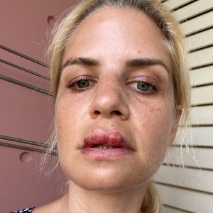 Lippe geschwollen: Susan Sideropoulos stürzte im Urlaub