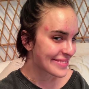 Herrlich uneitel: Tallulah Willis setzt ihre Akne in Szene