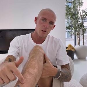 Influencer Tobias Wolf fallen die Haare am ganzen Körper aus