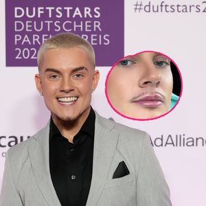 Twenty4tim zeigt das Ergebnis seiner Lippenunterspritzung