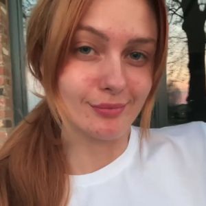 Hautprobleme: Vanessa Tamkan lernte, mit Makeln umzugehen