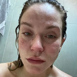Total aufgelöst: Vicky Pattison hat eine Zyste am Eierstock