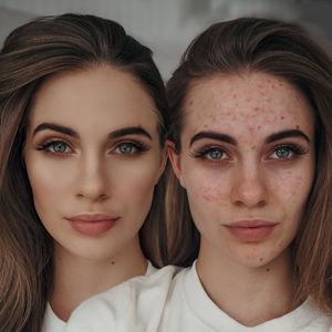 Influencerin Lisa-Marie Schiffner steht zu Hautproblemen