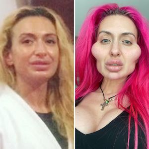 Wangenfiller-Sucht: So sah Anastasiia Pokreshchuk vorher aus