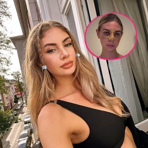 Nach der Trennung: Yasmin Vogt hatte eine Nasenoperation