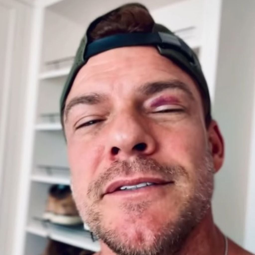 Alan Ritchson kassiert bei "Reachers"-Dreh blaues Auge, Juli 2025