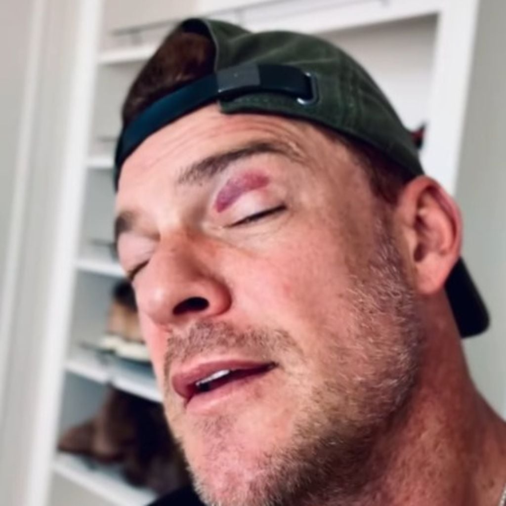 Alan Ritchson mit einem blauen Auge, Juli 2025
