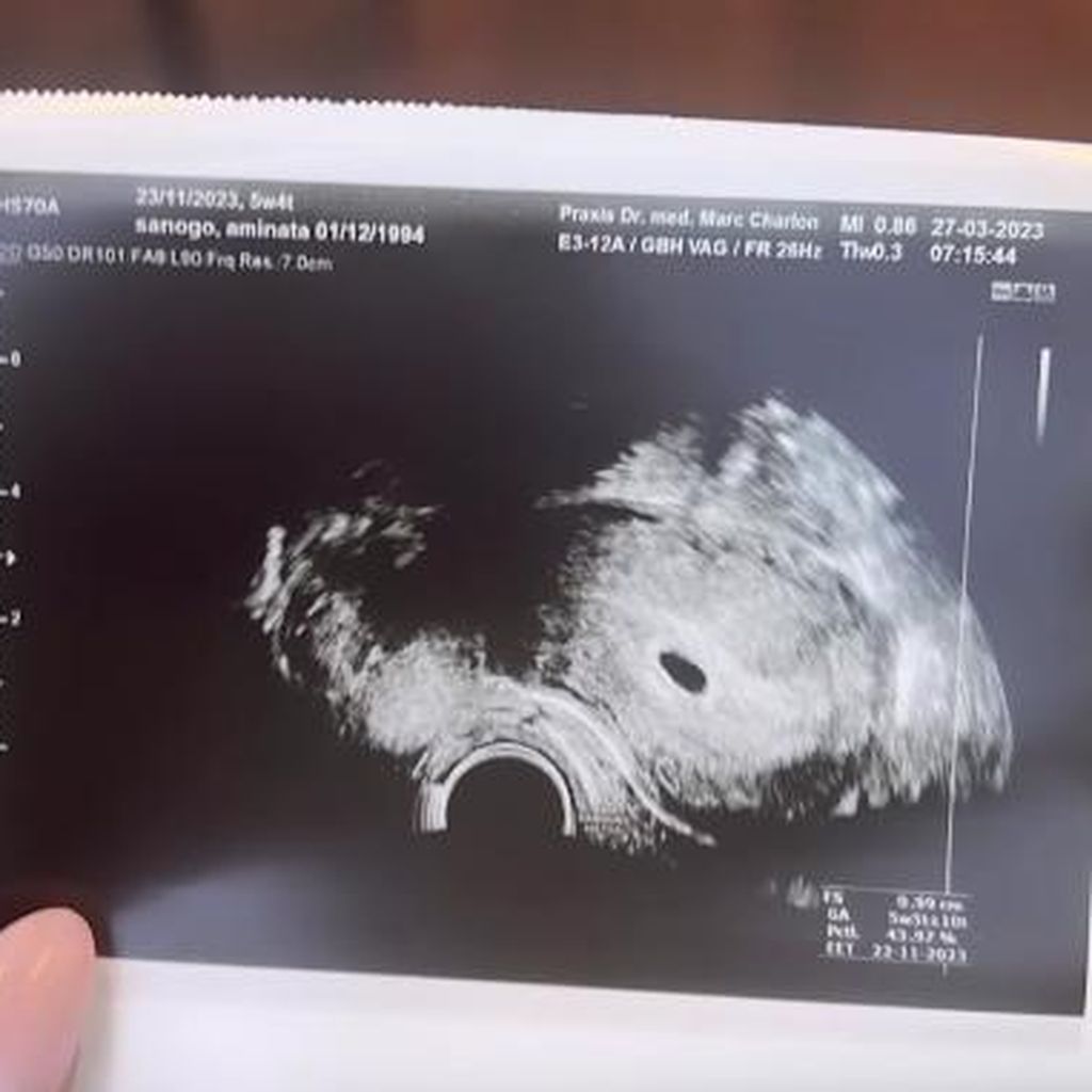 Aminata Sanogos Ultraschallbild