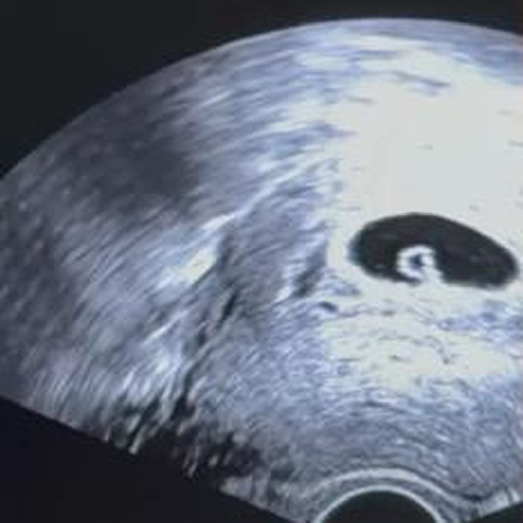 Babu zeigt eine Ultraschallaufnahme von ihrem verlorenen Baby