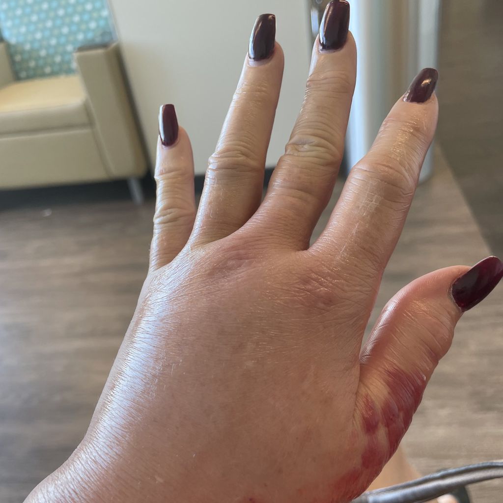 Brandi Glanvilles geschwollene Hand im August 2021