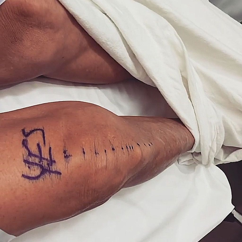 Caitlyn Jenners Knie vor der OP
