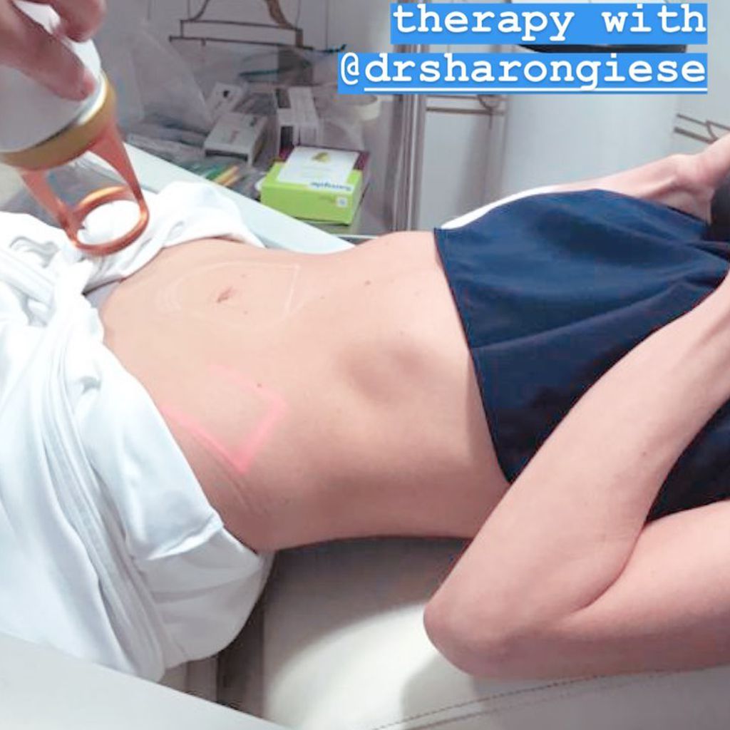 Candice Swanepoel lässt sich den Bauch straffen