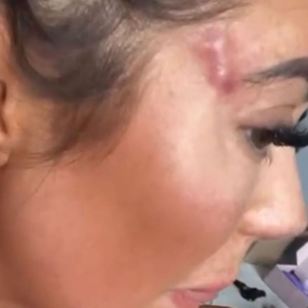 Chloe Ferry zeigt ihre OP-Narben