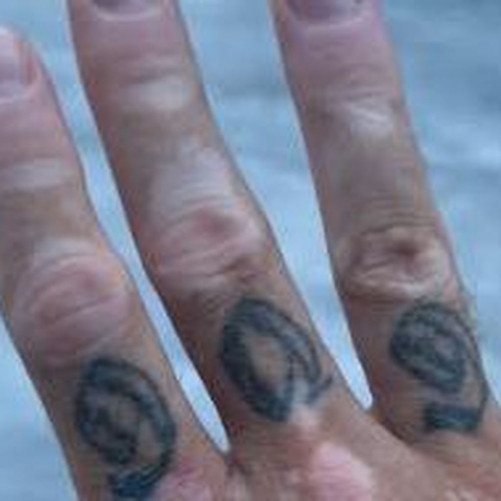 Chris Broys Vitiligo